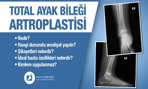 Total Ayak Bileği Artroplastisi Hakkında Bilinmesi Gerekenler